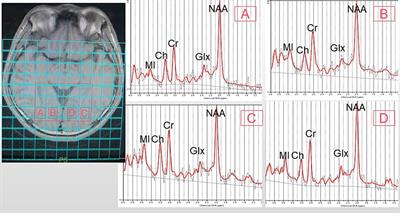 3.0 T multi-parametric MRI reveals metabolic and microstructural abnormalities in the posterior visual pathways in patients with thyroid eye disease